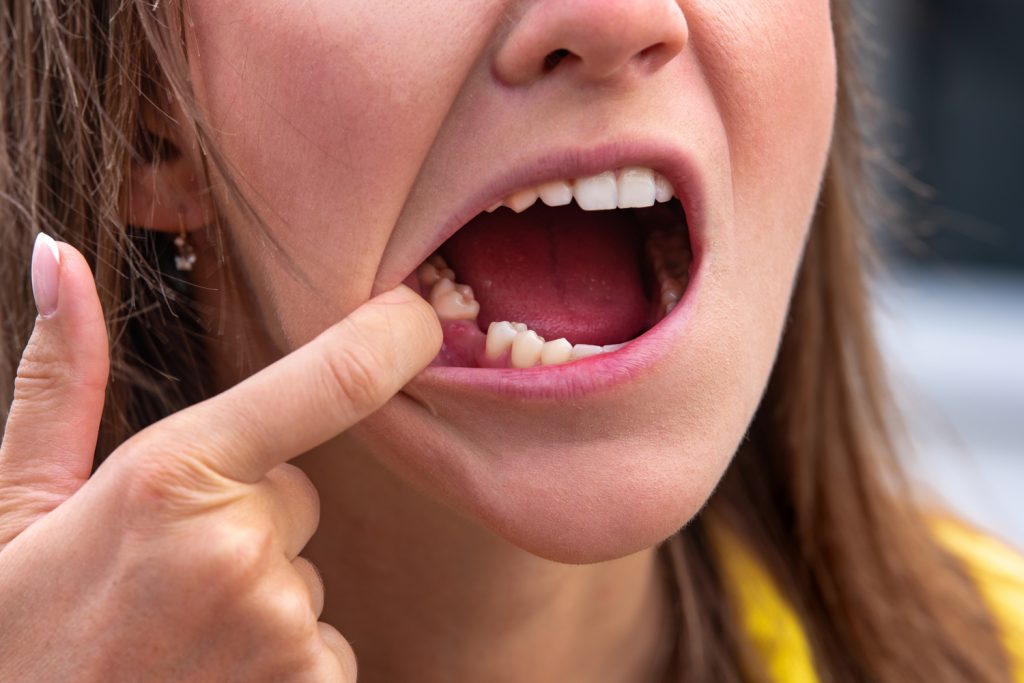 missing teeth from gum recession